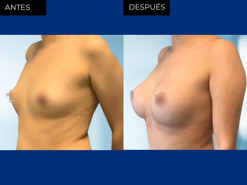 Antes y después aumento de busto con implantes mamarios en Chihuahua
