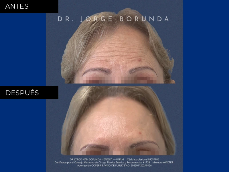 Resultados medicina estética, botox y ácido hialurónico en Chihuahua