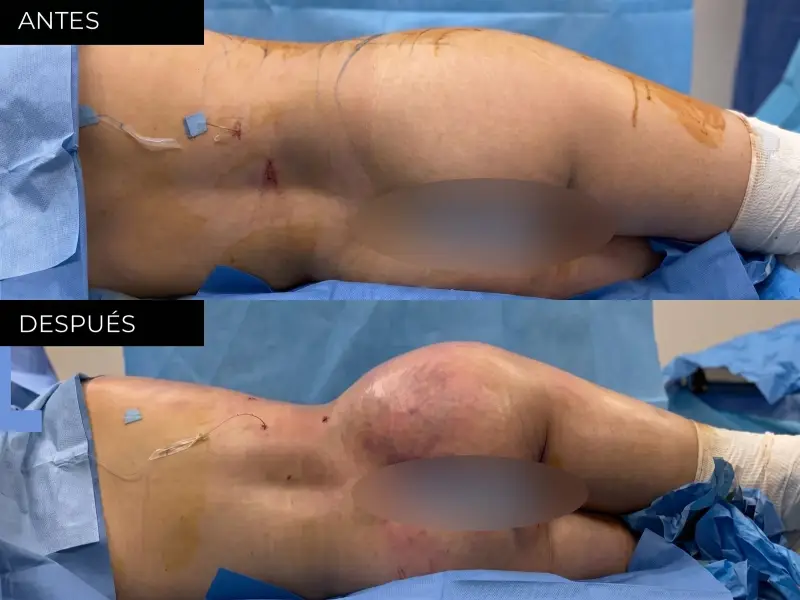 Antes y después liposucción y contorno corporal en Chihuahua