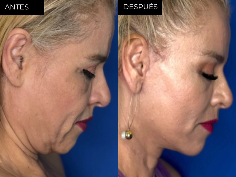 Antes y después rinoplastia y cirugía facial en Chihuahua