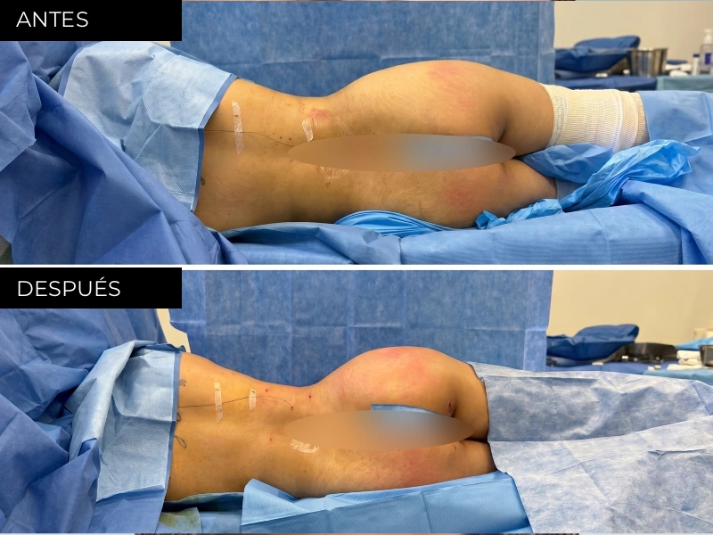 Antes y después liposucción y lipoescultura en Chihuahua