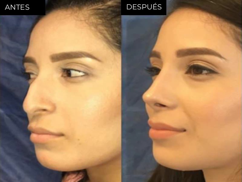 Antes y después rinoplastia estética y funcional en Chihuahua