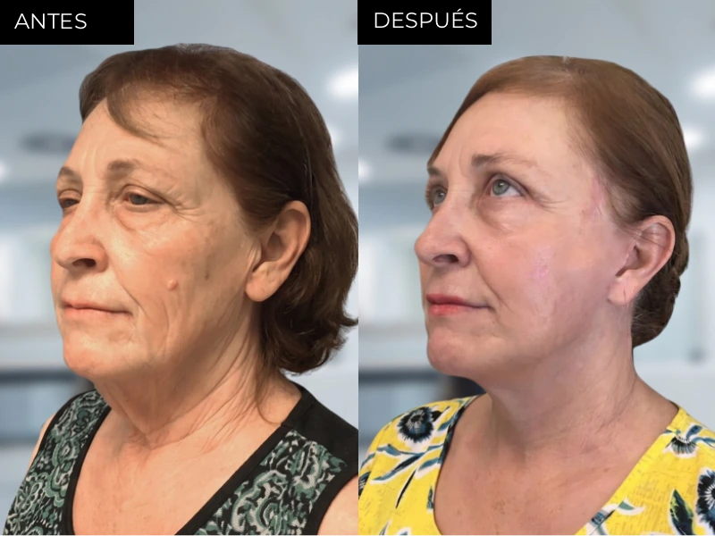 Antes y después lifting facial ritidectomía en Chihuahua